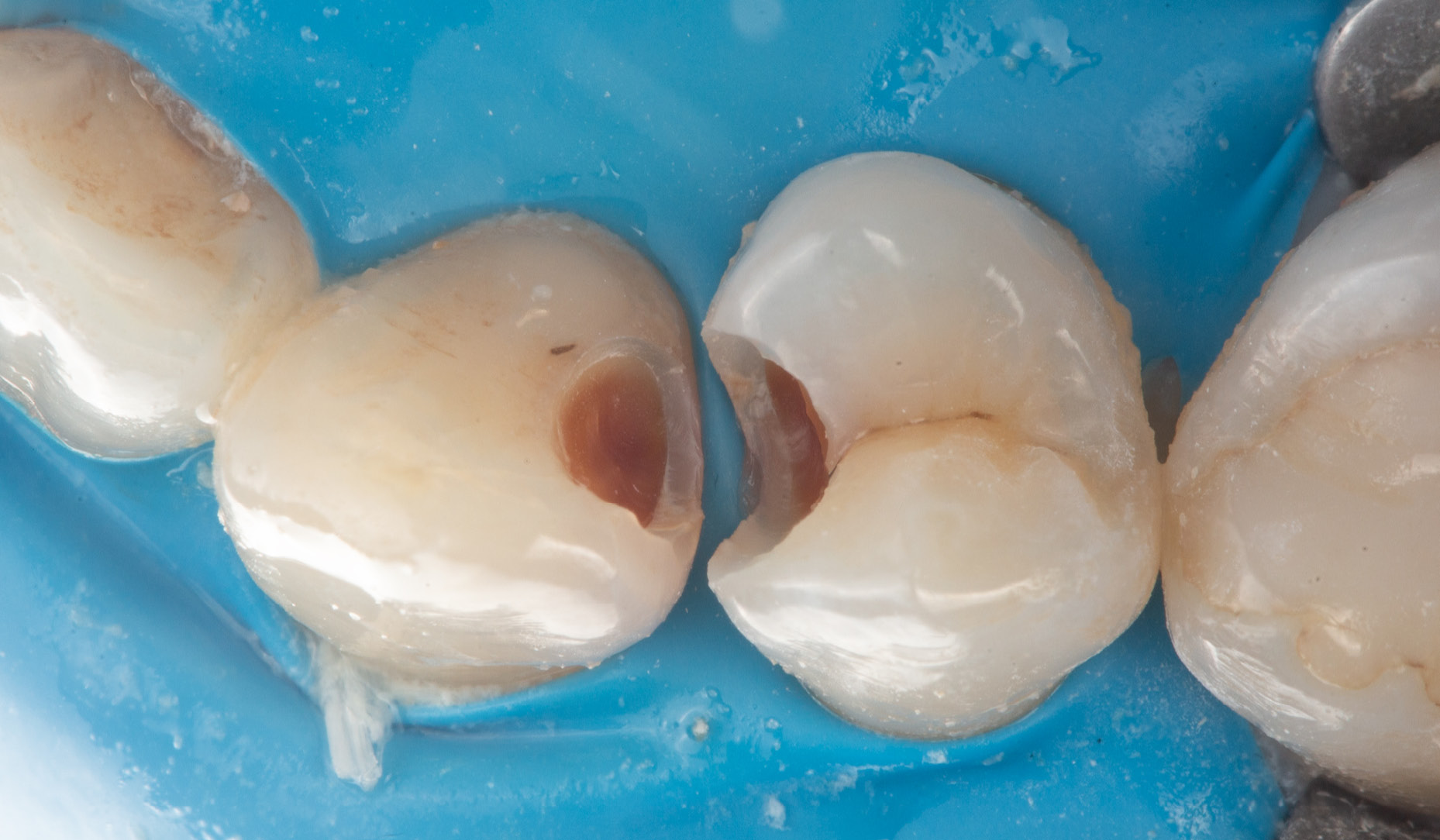 Fig. 2: Clinical situation after caries excavation